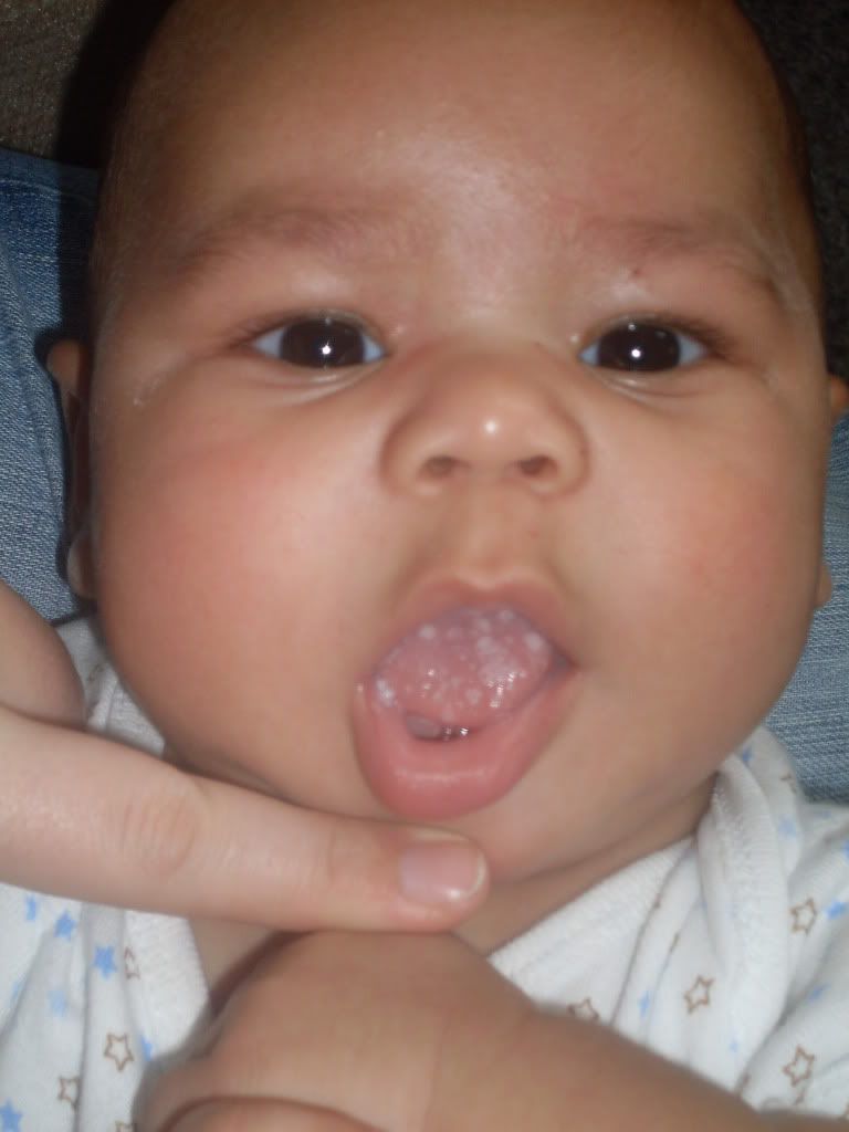 infant thrush tongue